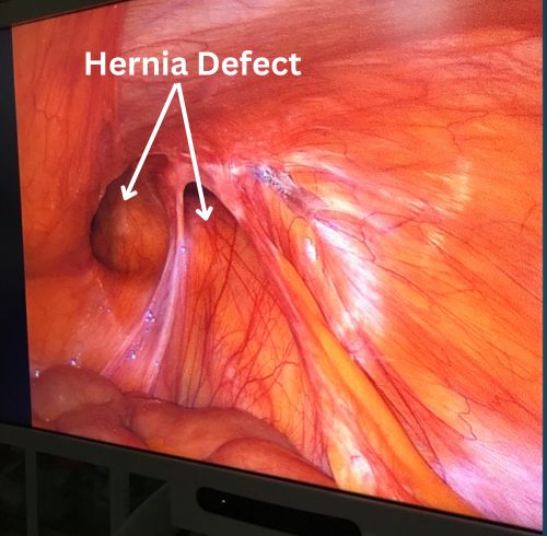 How Laparascopic Hernia Repair surgery is performed