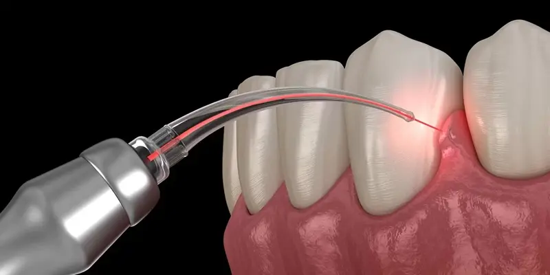 How Does Laser Dentistry Work Without Causing Pain?