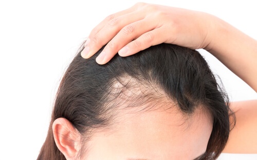 What are the causes of Hair Loss?