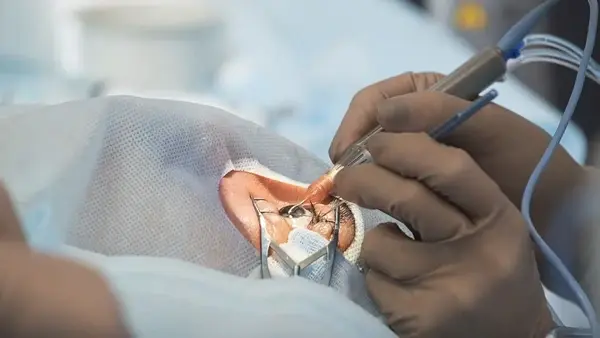 The Turning Point: Signs It’s Time to Consider Cataract Surgery